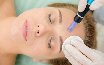 Microneedling